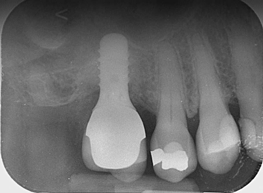 Periimplantitis radiograph before treatment